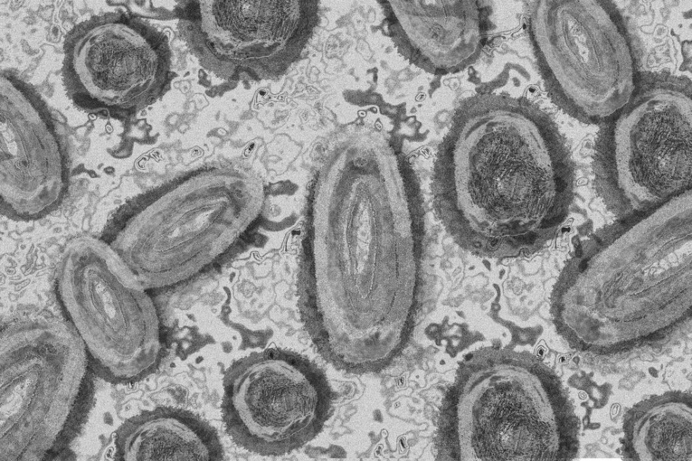 Imagen de microscopio electrónico que muestra las partículas del virus de la viruela del mono. …