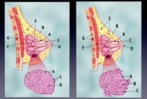 En la imagen del lado izquierdo se muestra un carcinoma lobulillar in situ (conocido como …